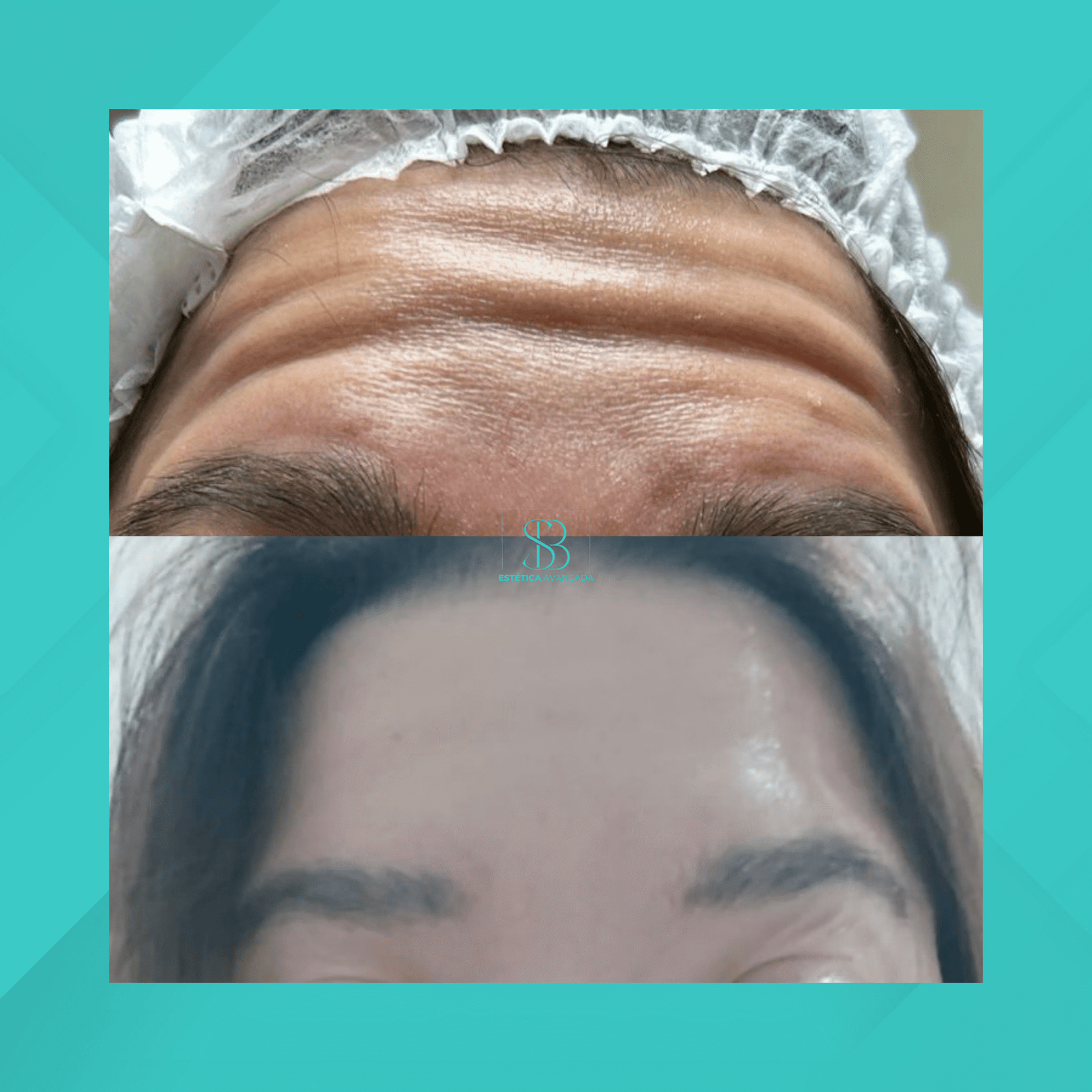 Dra. Simone Balestero. Botox. #1.1