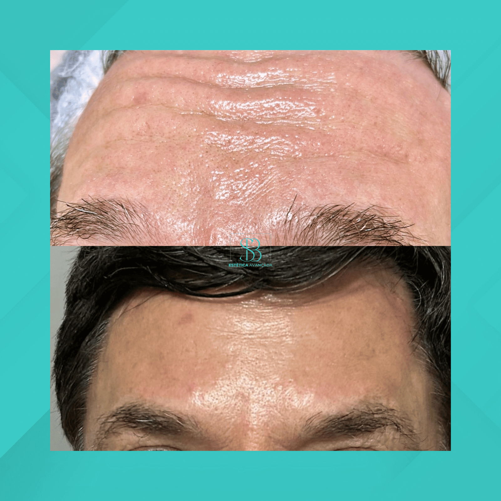 Dra. Simone Balestero. Botox. #2.1