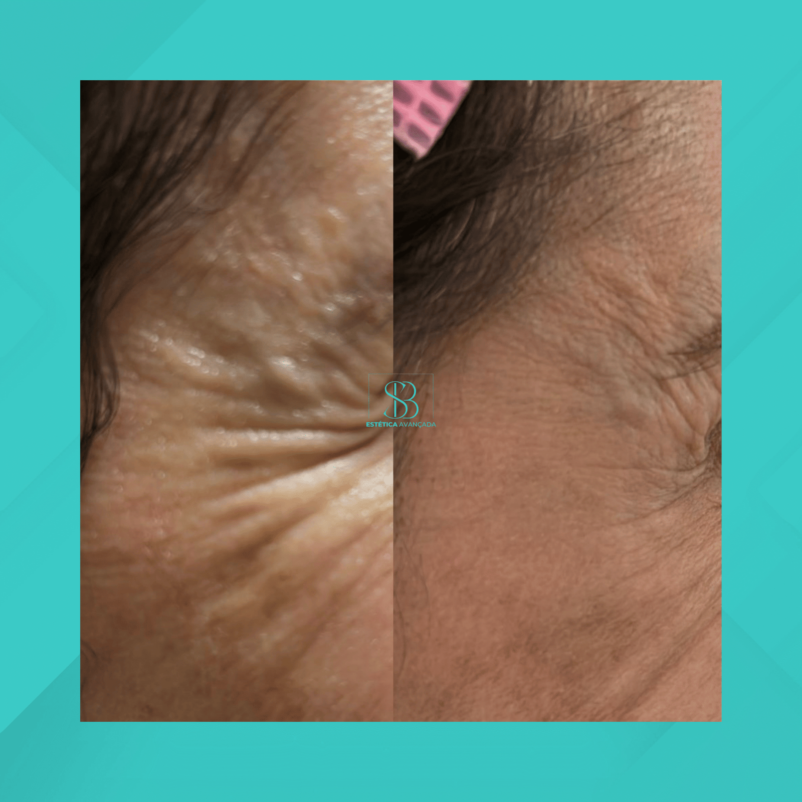 Dra. Simone Balestero. Botox. #3.1