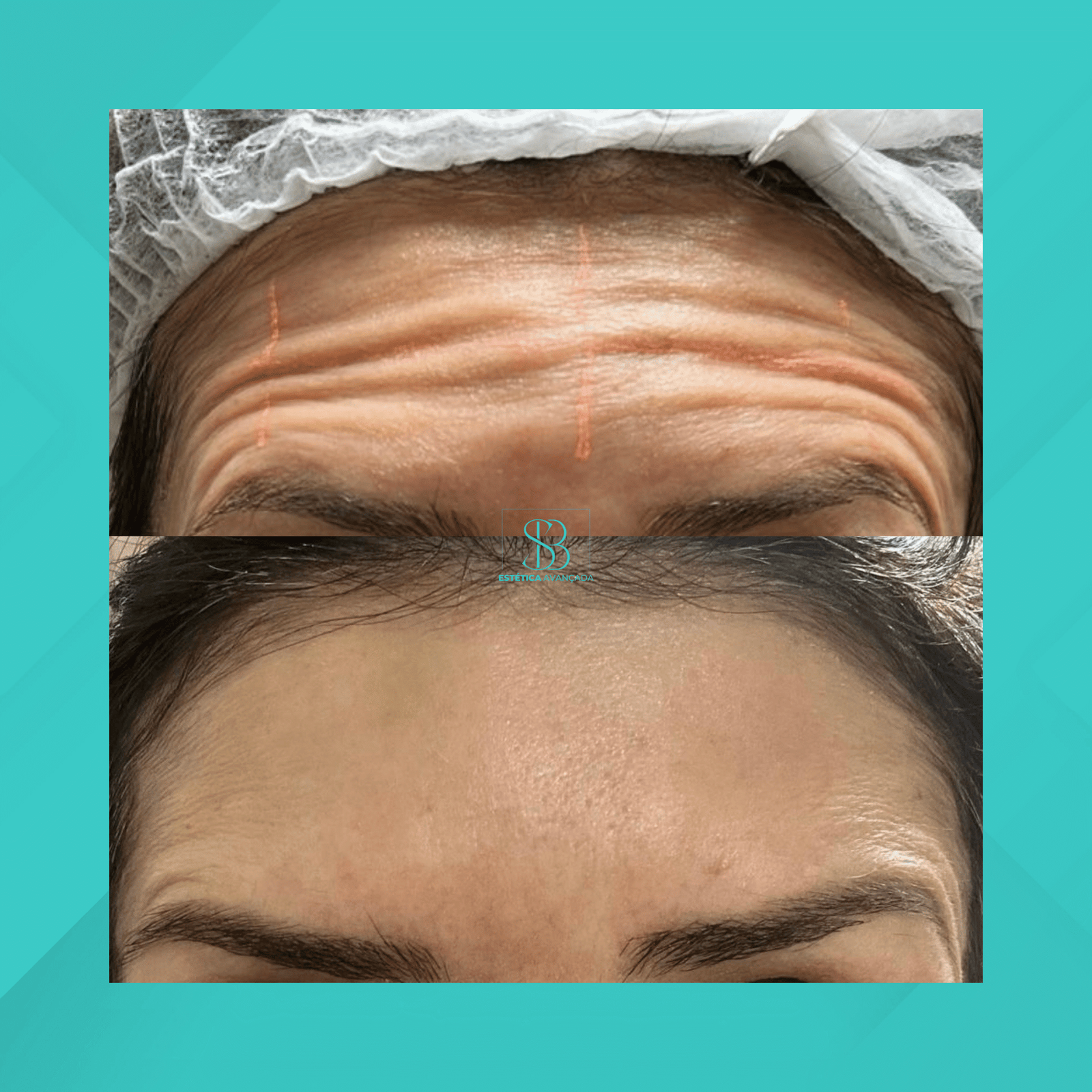 Dra. Simone Balestero. Botox. #4.1