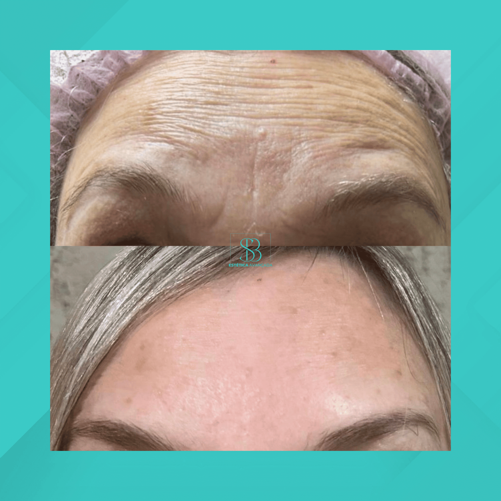 Dra. Simone Balestero. Botox. #5.1