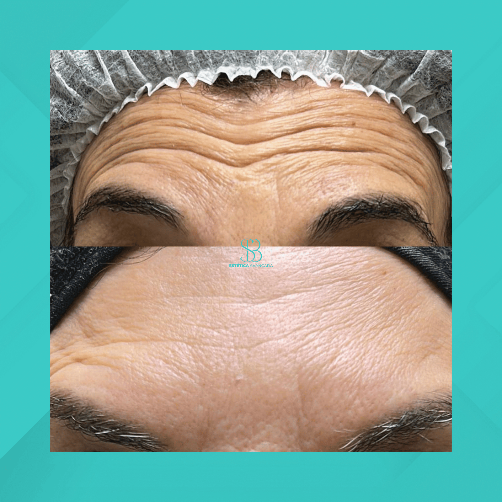 Dra. Simone Balestero. Botox. #6.1