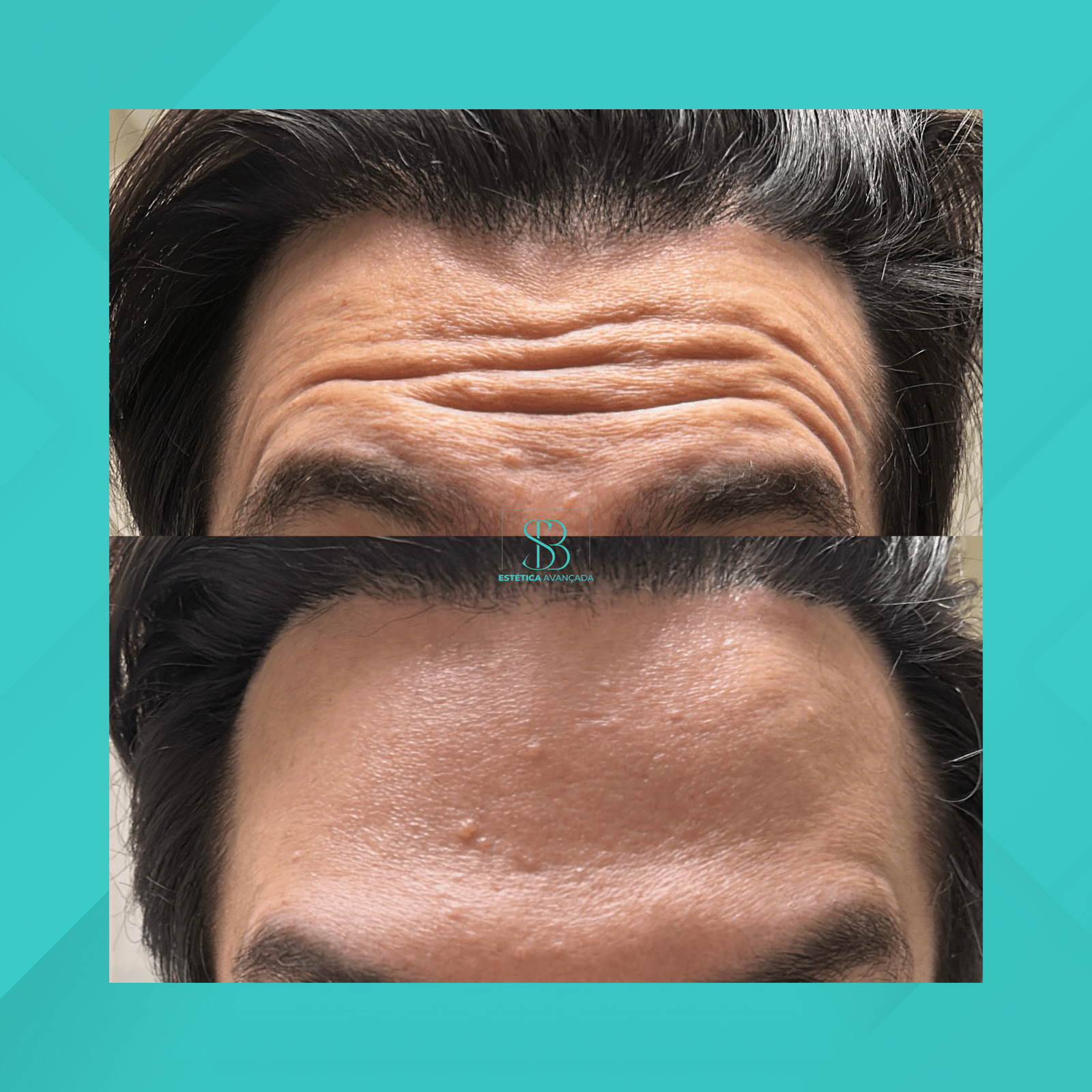 Dra. Simone Balestero. Botox. #7.1