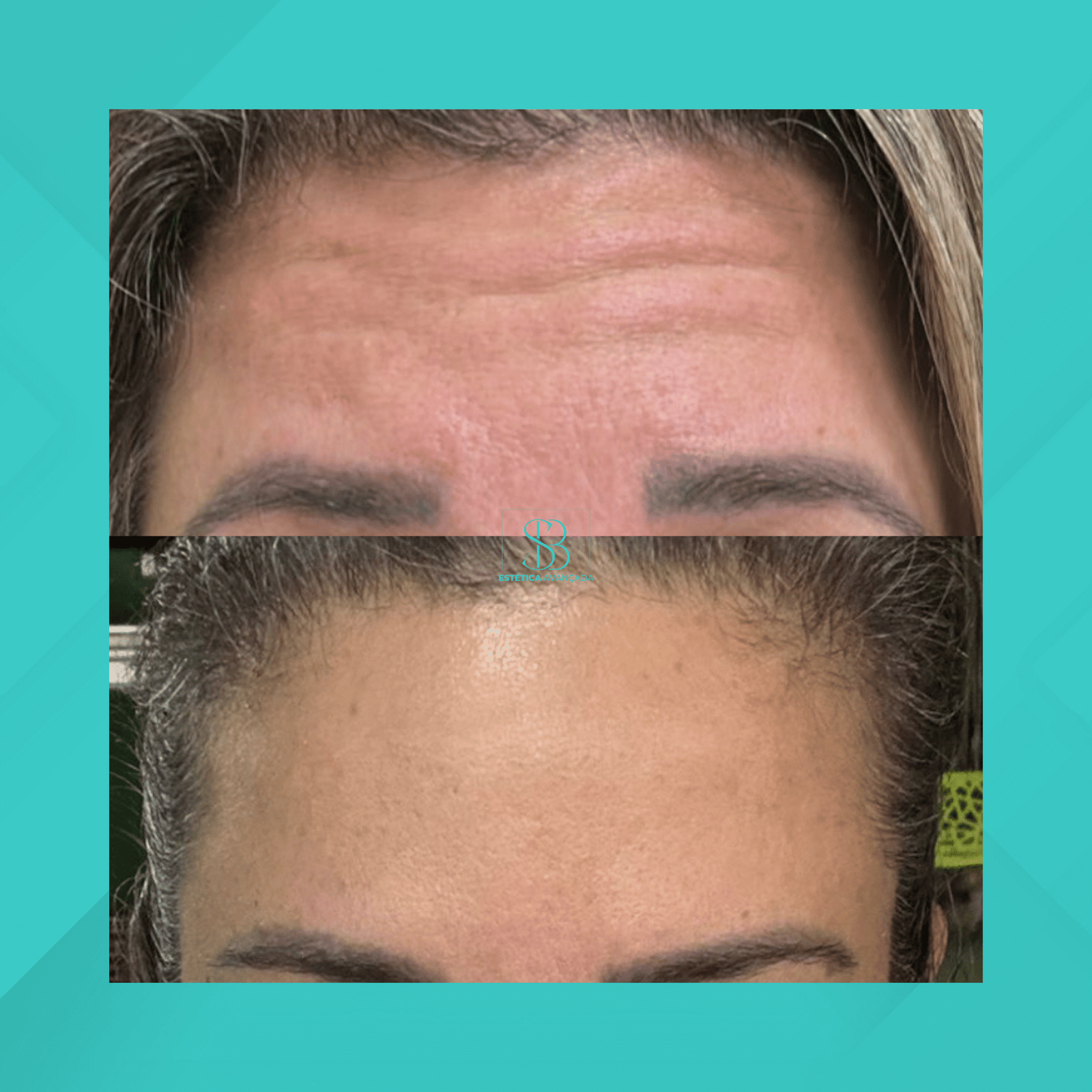 Dra. Simone Balestero. Botox. #8.1