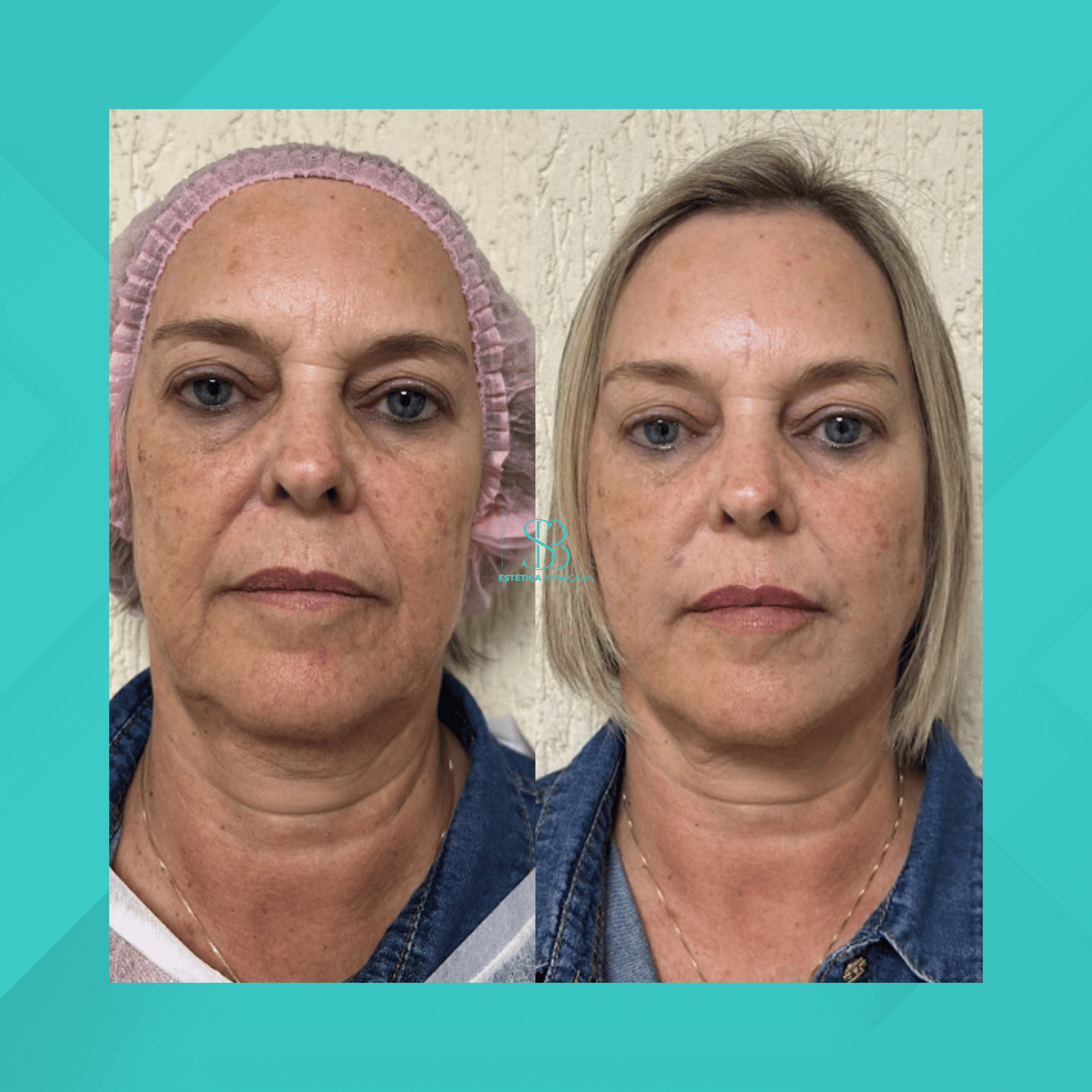 Dra. Simone Balestero. Fios de Sustentação. #1.1