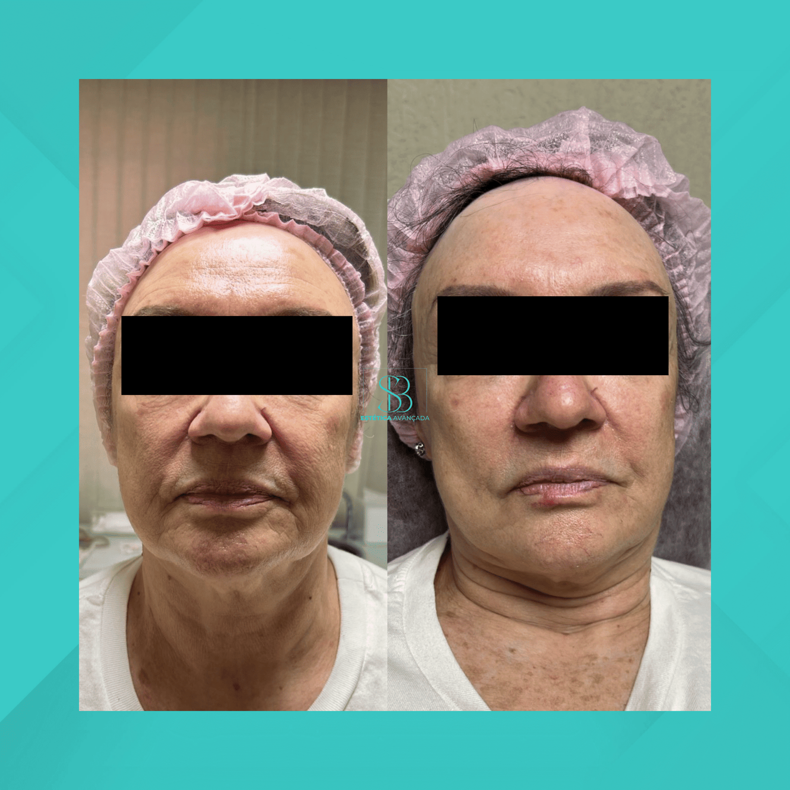 Dra. Simone Balestero. Microagulhamento. #1.1