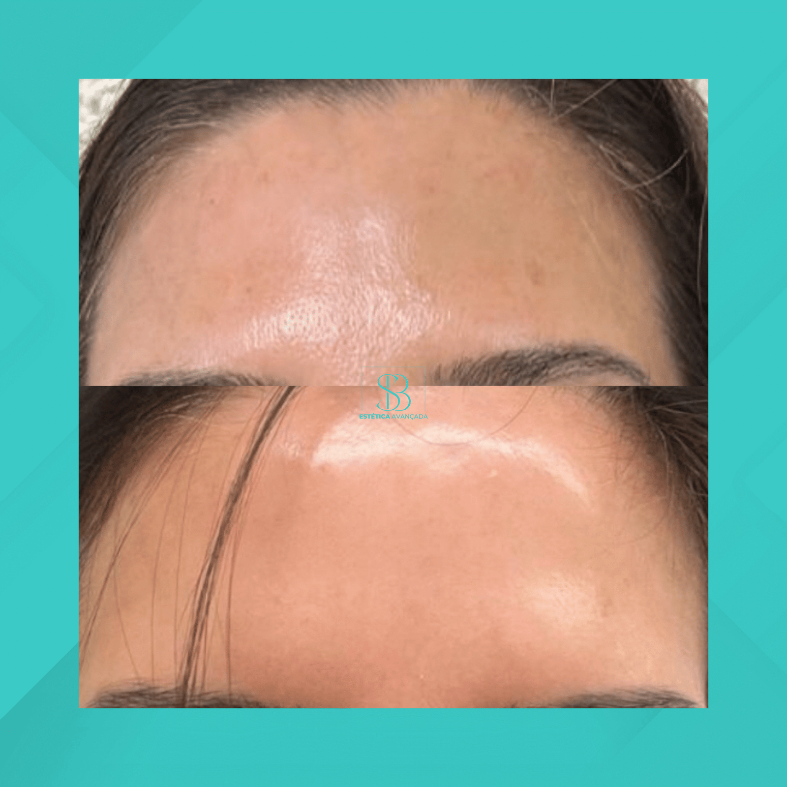 Dra. Simone Balestero. Peeling Coreano. #1.1