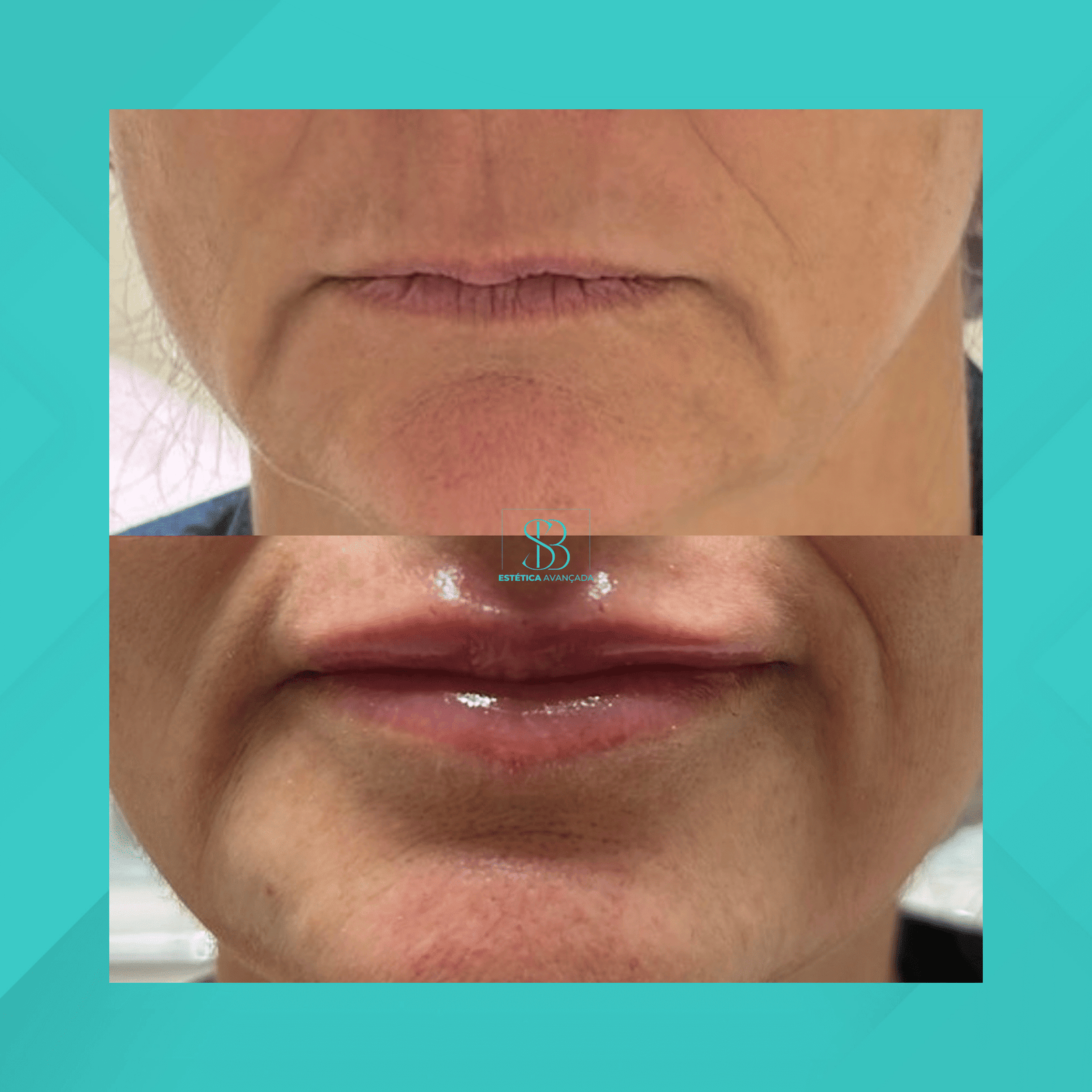 Dra. Simone Balestero. Preenchimento Labial. #1.1