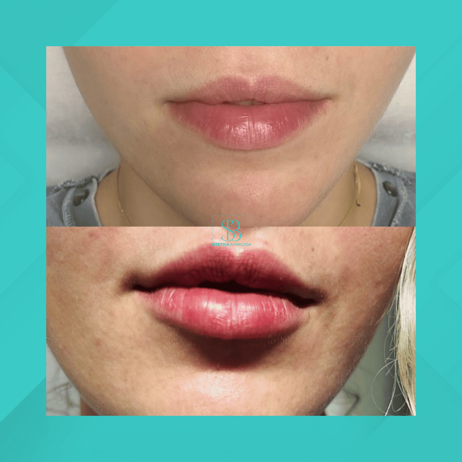 Dra. Simone Balestero. Preenchimento Labial. #2.1