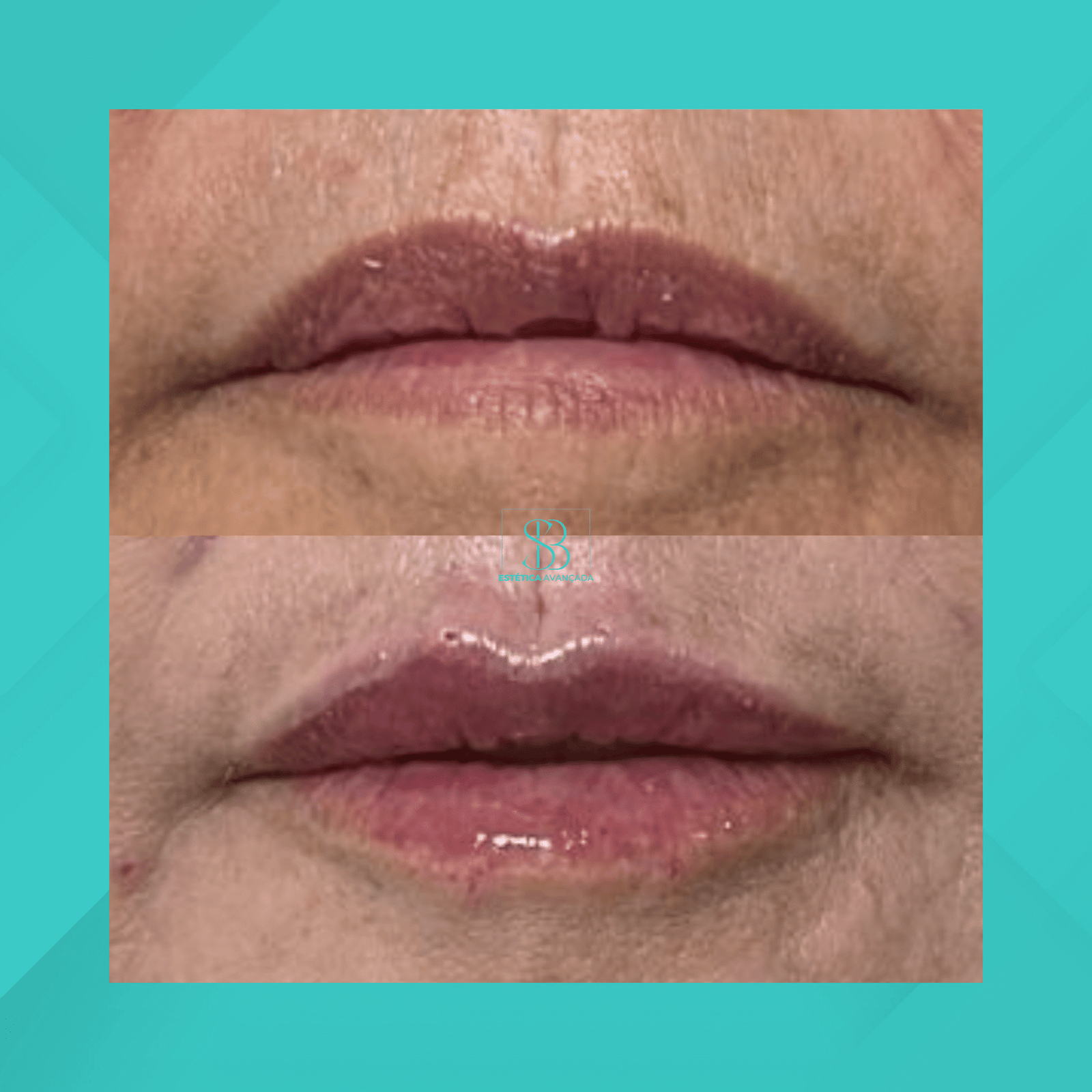 Dra. Simone Balestero. Preenchimento Labial. #3.1